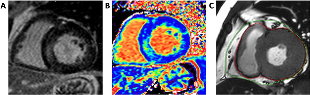 Response of the myocardium to hypertrophic conditions in the adult ...